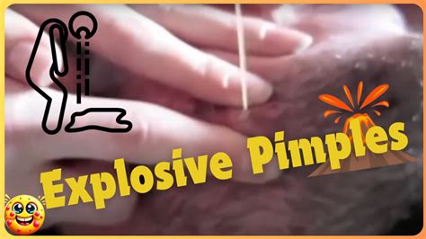ow to skincare, <b>popping</b> big <b>pimples</b>, cystic acne removal close up, dilated pore of winer , <b>pimple</b> popper blackhead on face, whiteheads around nose,blackhead. . You tube videos pimple popping